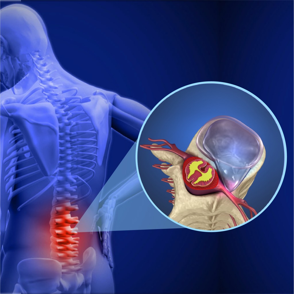  Hérnia de disco: doença pode diminuir ou sumir?