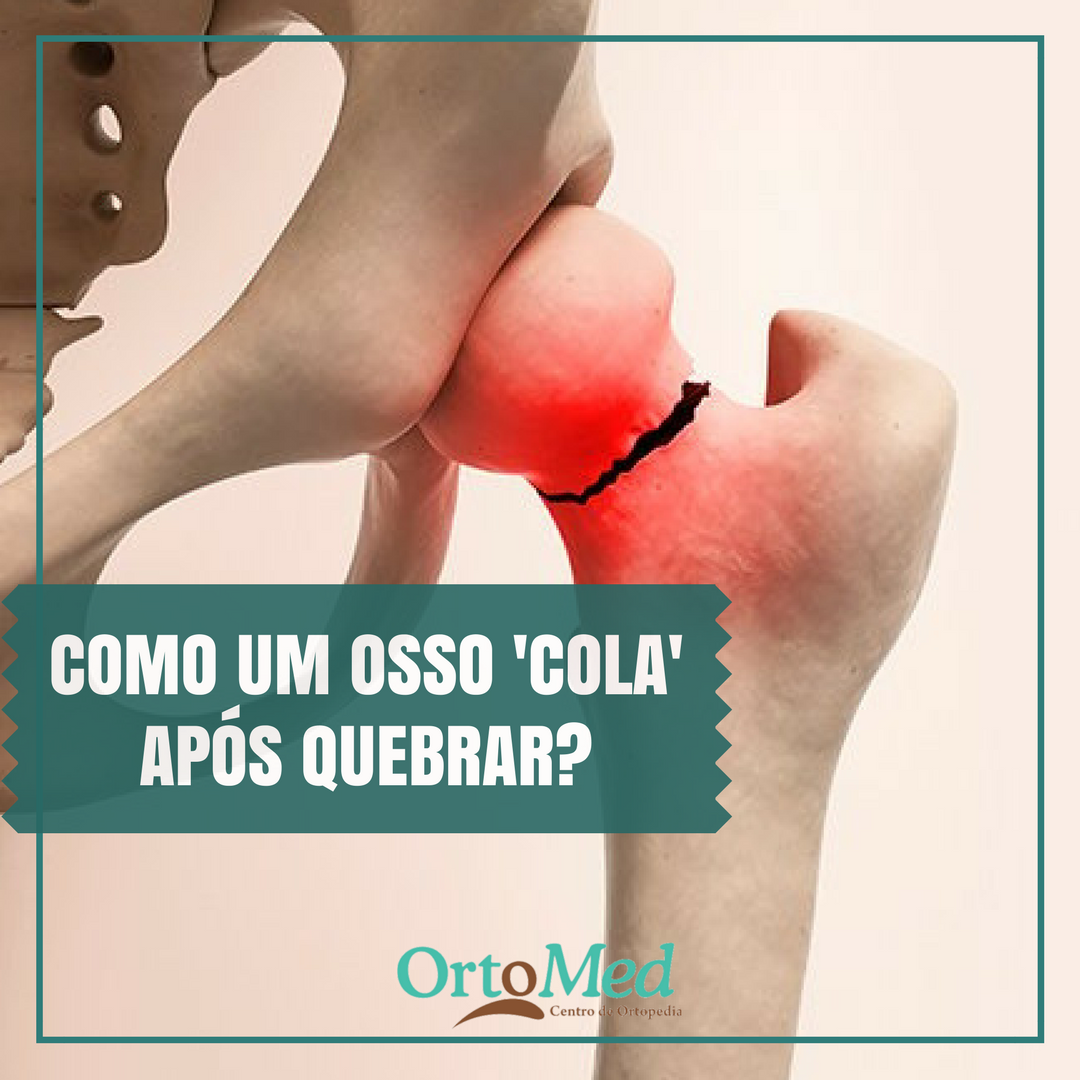 Entenda como o corpo promove a recomposição de um osso fraturado 